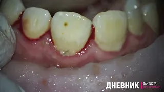 чистка зубов ультразвуком и удаление зубного камня