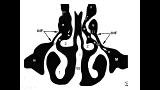 Nose and Paranasal Sinus CT scan