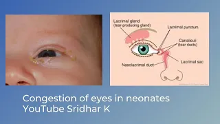 Is my baby's eyes infected? What is this sticky discharge? Dr Sridhar K