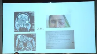 AIOC2022 FP525 PPP   Ocular Pathology topic ORBITAL LYMPHOMA A CLINICO PATHOLOGICAL CORRELATION