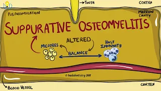 Suppurative Osteomyelitis of the jaw