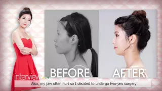 Korea Double Eyelid Surgery, V-line surgery, Jawline Surgery and Orthognathic surgery Result