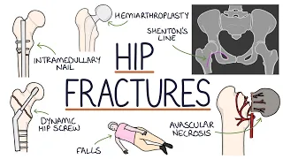 Understanding Hip Fractures and Hip Surgery