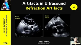 Artifacts in Ultrasound 4: Refraction Artifact