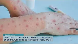 Sertãozinho confirma primeiro caso da varíola dos macacos