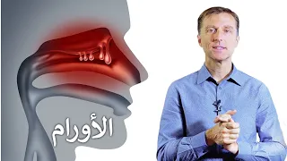 الزوائد و الأورام الحميدة (سلائل) سببها ونصيحة دكتور بيرج