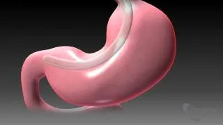 Sleeve Gastrectomy