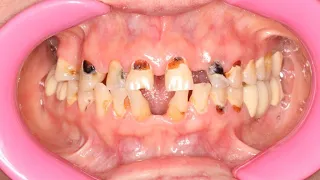 Surgical crown lengthening