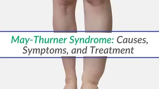 May Thurner Syndrome: Causes, Symptoms & Treatment