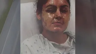 Attacker Throws Acid in Woman's Face on Long Island