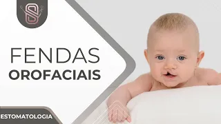 Fendas Orofaciais - Patologia Oral