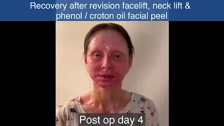 My Video Diary Part 1 | Revision facelift, necklift & facial phenol / croton oil peel | First week