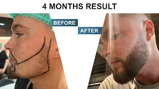 Beard Transplant in Turkey - Result in 4 month (Hermest)