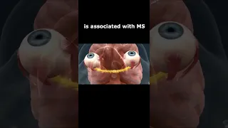 Does optic neuritis always mean MS ?