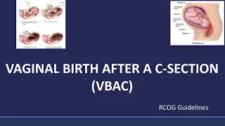 Vaginal Birth After Cesarean (VBAC), RCOG Guideline