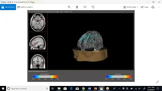 Webinar  Functional Brain Mapping and Neuromodulation  In the Treatment of Autism