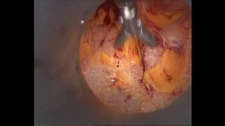 Dr.Nikita Trehan-Laparoscopic Inguinal Anatomy - 2