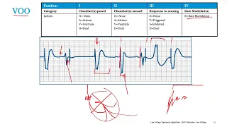 Pacemaker Mode Selection and 12 Lead ECG Interpretation of STEMI  - Port Harcourt Pacing
