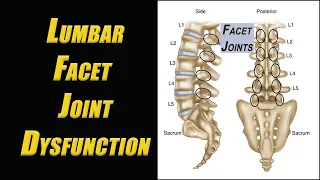 Get Rid of Low Back Pain with 3 Excellent Exercises to Treat Lumbar Facet Joint Dysfunction