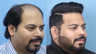 Patient Testimonial - Norwood Grade 5 baldness, 4596 grafts and a 15-month update at Eugenix.