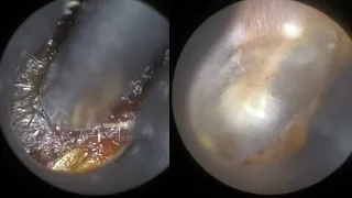 53 - Amazing Magnification, Clarity & Focus offered by WAXscope®️ when performing Ear Wax Removal