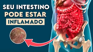 INTESTINO INFLAMADO: Sintomas de Doença Inflamatória Intestinal │ Doença de Crohn