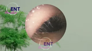 ANIKA ENT | Earwax removal by a health care provider #307