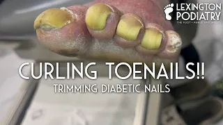 Curling Toenails! Trimming Diabetic Nails