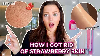 How I Got Rid of My Strawberry Skin for GOOD | My Experience with Truly Beauty!