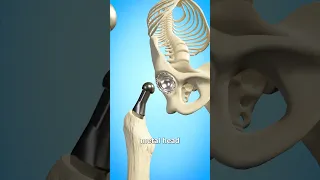 Total Hip Replacement 🤔 (Explained)