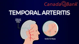 Temporal Arteritis