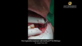 Лечение периимплантита с помощью лазера LiteTouch™ Er:YAG