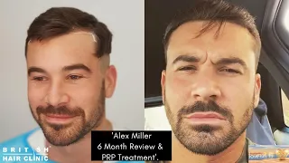 The British Hair Clinic - Alex Miller gives a 6 Month update on his hair.