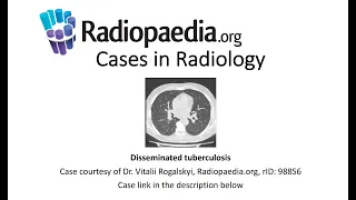 Disseminated tuberculosis (Radiopaedia.org) Cases in Radiology