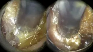 175 - Dead Skin & Ear Wax Compacting the Entire Ear Removed using the WAXscope®️