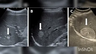 Liver Hemangioma