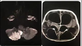 1#Radiology# spotters 1#15 cases in 15 minutes #cns#neurororadiology#mri#ct#xray#radiopedia#anatomy#