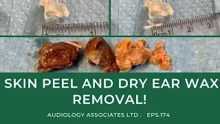 SKIN PEEL AND DRY EAR WAX REMOVAL - EP 174