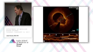 Defining the Cause of FMD and Redefining Our Understanding of Spontaneous Arterial Dissection