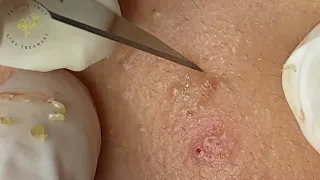 SAC DEP SPA Blackheads | #855