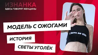 Модель с ожогами. Как Света Уголёк живет сейчас