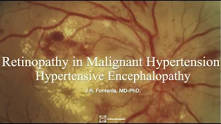 Hypertensive Retinopathy in Malignant Hypertension. Hypertensive Encephalopathy.