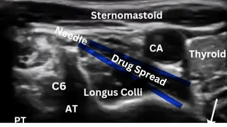 Stellate Ganglion Block for CRPS