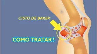 CISTO DE BAKER, COMO TRATAR?! #joelho #dor #alivio #tratamento #fisioterapia
