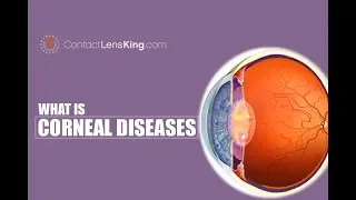 Corneal Diseases of the Eye | Keratoconus, Fuchs' Endothelial Dystrophy, Bullous Keratopathy