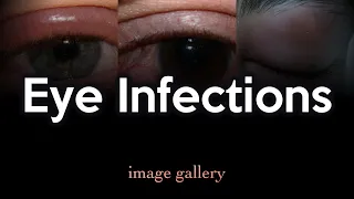 Eye Infections: Image Gallery