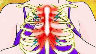 How to get rid of Costochondritis Pain in just 3 minutes!
