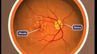 Дистрофия сетчатки центральная