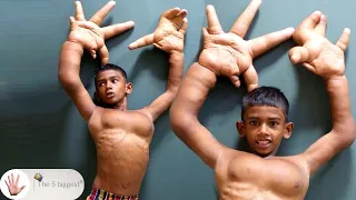 The Boy With The Giant Hands: Watch His Transformation! ~ Body Bizarre!