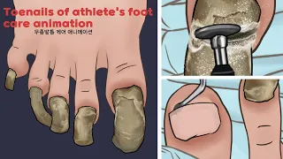 ASMR Satisfying Toenail of Athlete's foot Treatment animation / Athlete's foot foot care / TINGLES!